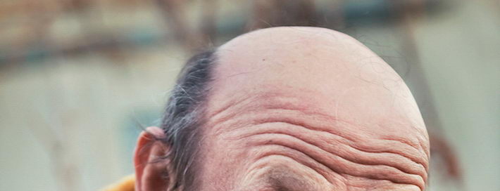 Do not want to baldness
